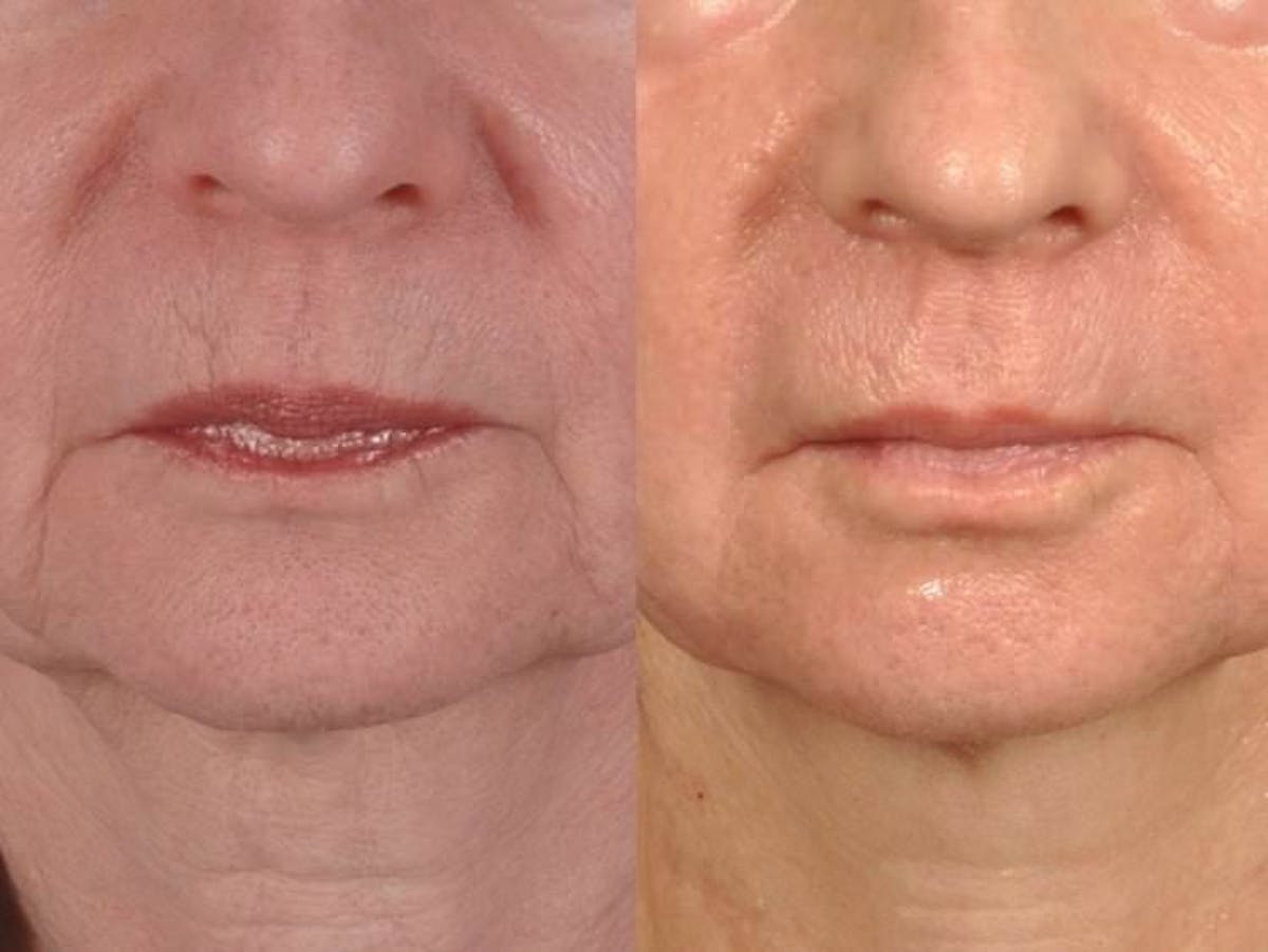 Microneedling Before & After Gallery - Patient 121377430 - Image 1