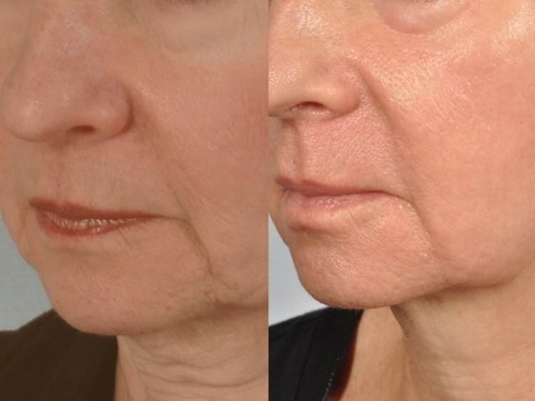 Microneedling Before & After Gallery - Patient 121377431 - Image 1