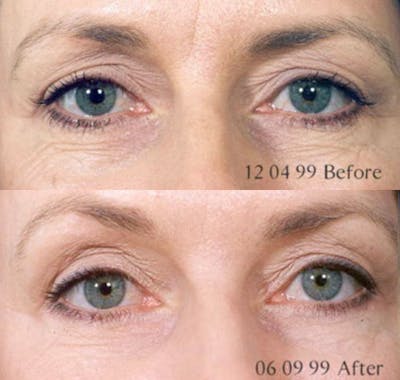 Microneedling Before & After Gallery - Patient 121377432 - Image 1