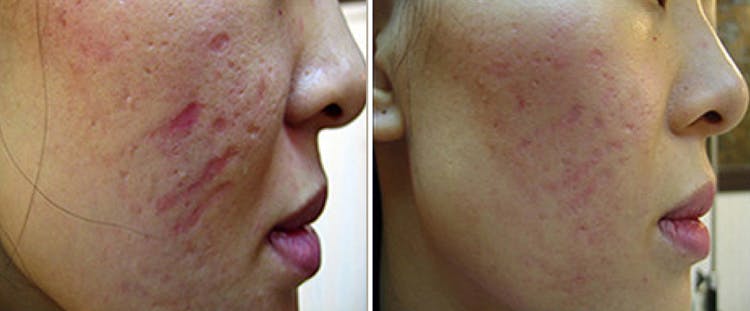 Microneedling Before & After Gallery - Patient 121377437 - Image 1