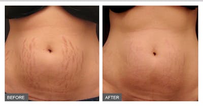 Microneedling Before & After Gallery - Patient 121377438 - Image 1