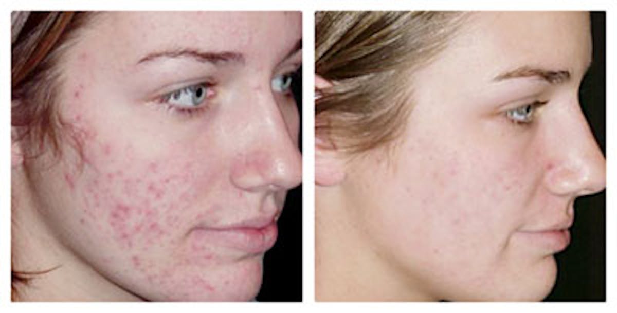 IPL Photofacial Before & After Gallery - Patient 121377447 - Image 1