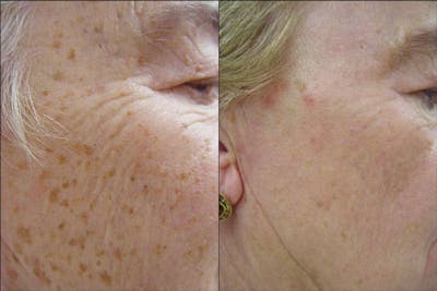 IPL Photofacial Before & After Gallery - Patient 121377454 - Image 1