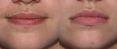 Laser Hair Removal Before & After Gallery - Patient 121377456 - Image 1