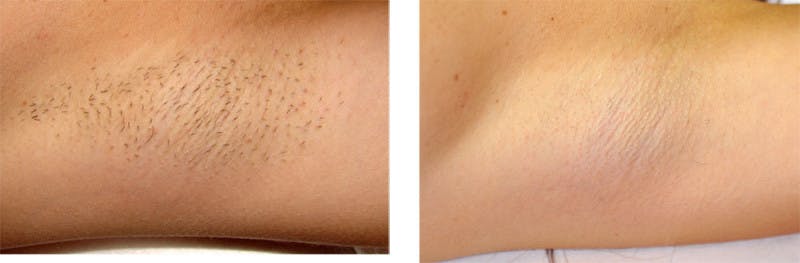 Laser Hair Removal Before & After Gallery - Patient 121377458 - Image 1