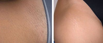 Laser Hair Removal Before & After Gallery - Patient 121377462 - Image 1
