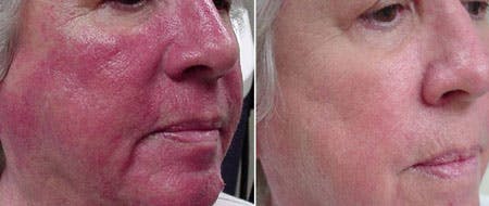 IPL Photofacial Before & After Gallery - Patient 121377463 - Image 1