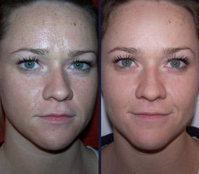 Peel & Medical Grade Skin Care Before & After Gallery - Patient 121377466 - Image 1