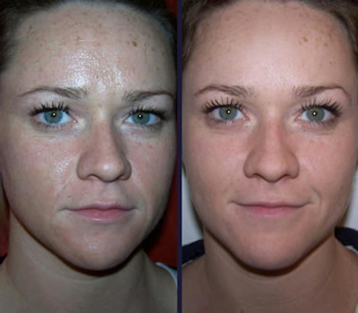 Peel & Medical Grade Skin Care Before & After Gallery - Patient 121377466 - Image 1