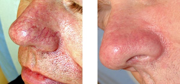IPL Photofacial Before & After Gallery - Patient 121377464 - Image 1