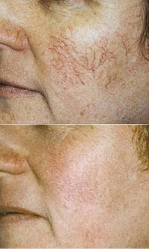 IPL Photofacial Before & After Gallery - Patient 121377471 - Image 1