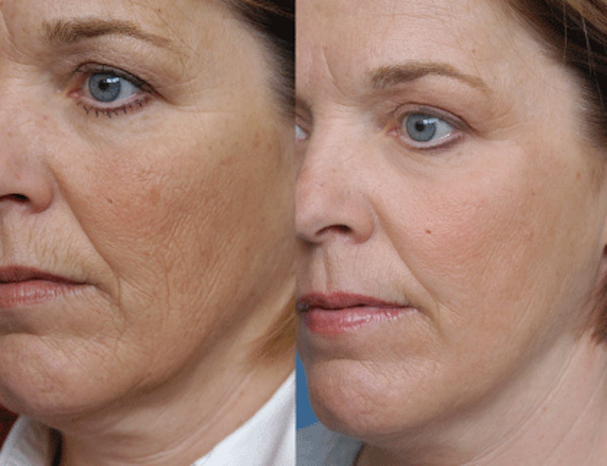 Peel & Medical Grade Skin Care Before & After Gallery - Patient 121377467 - Image 1