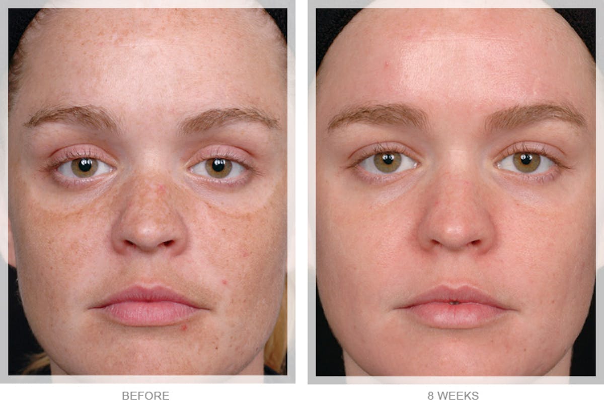 Peel & Medical Grade Skin Care Before & After Gallery - Patient 121377468 - Image 1
