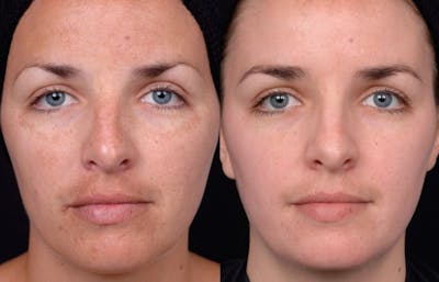 Peel & Medical Grade Skin Care Before & After Gallery - Patient 121377483 - Image 1