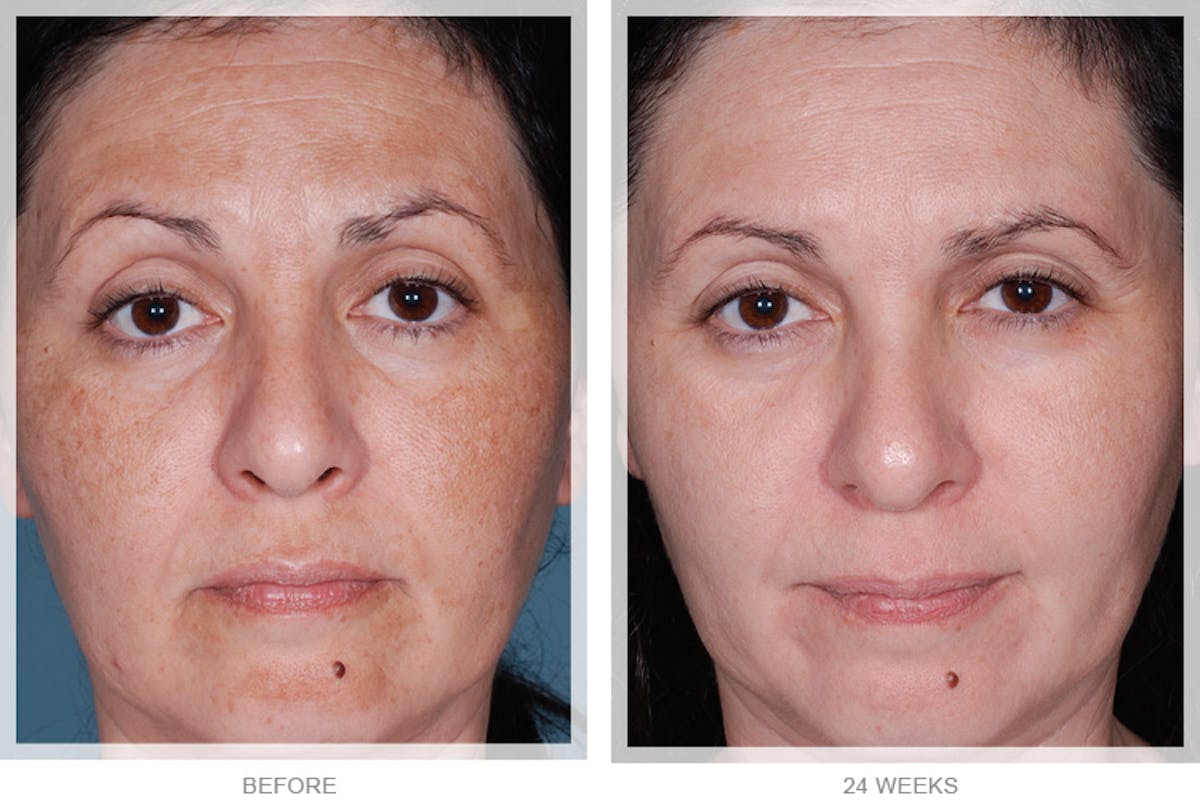 Peel & Medical Grade Skin Care Before & After Gallery - Patient 121377500 - Image 1