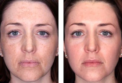 Peel & Medical Grade Skin Care Before & After Gallery - Patient 121377510 - Image 1