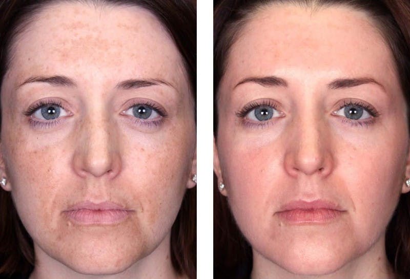 Peel & Medical Grade Skin Care Before & After Gallery - Patient 121377510 - Image 1
