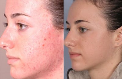 Peel & Medical Grade Skin Care Before & After Gallery - Patient 121377512 - Image 1