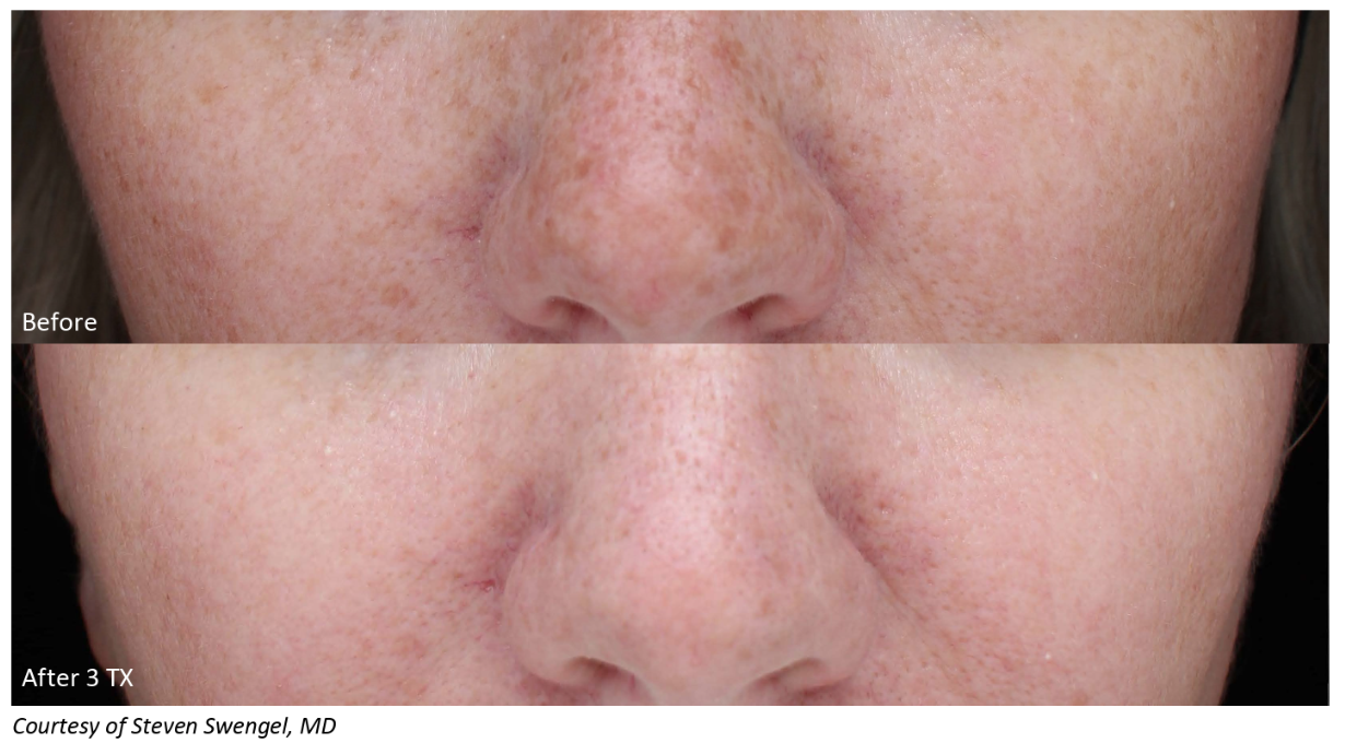 before and after image of skin tightening in Denver