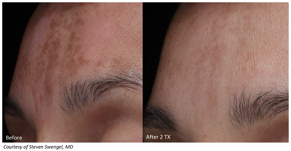 before and after image of LaseMD skin tightening in Denver