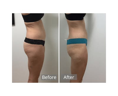 Medical Weight Loss Before & After Gallery - Patient 122404034 - Image 1