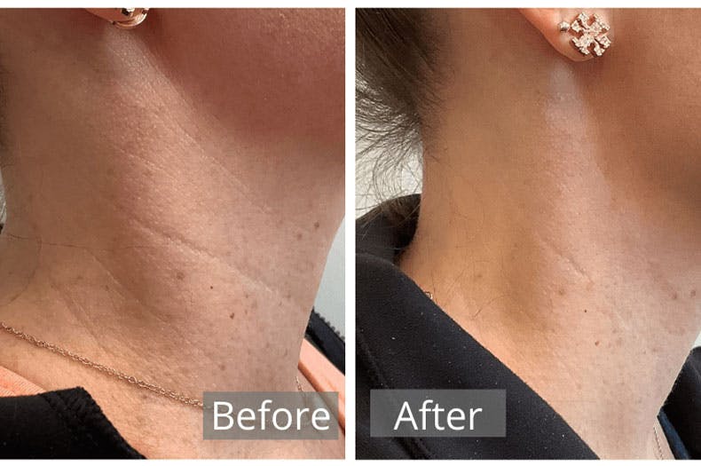 Dermal Fillers Before & After Gallery - Patient 122404084 - Image 1