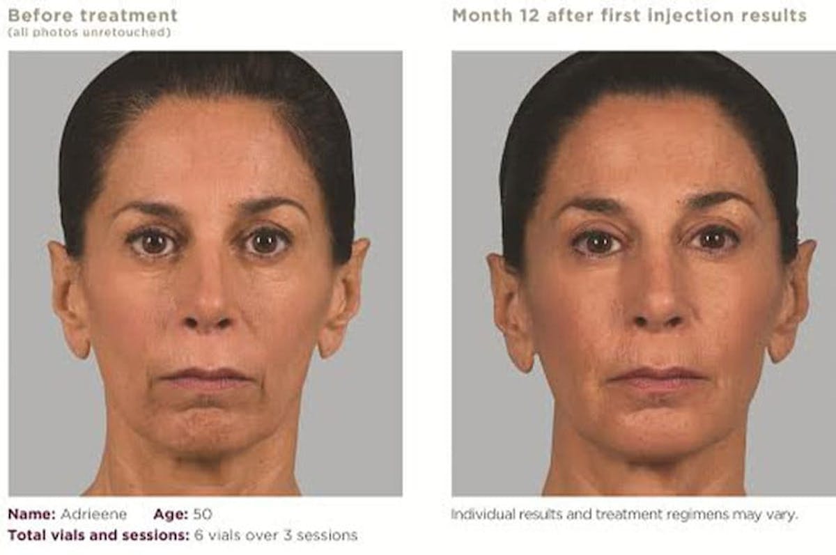 Sculptra Before & After Gallery - Patient 153156420 - Image 1