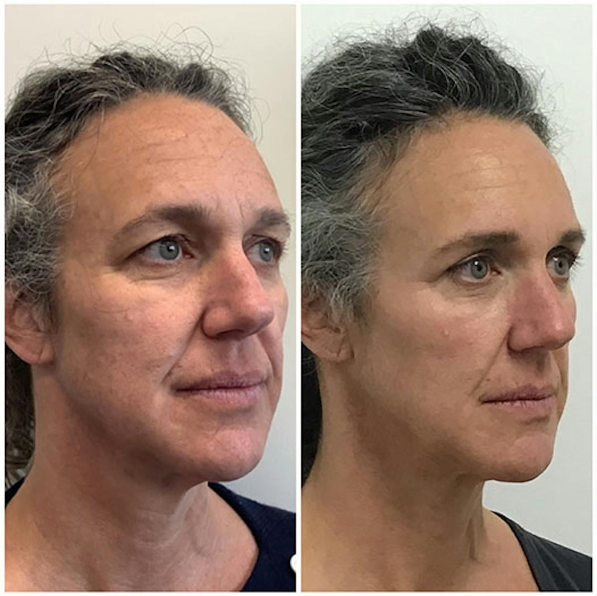 Sculptra Before & After Gallery - Patient 153156494 - Image 1