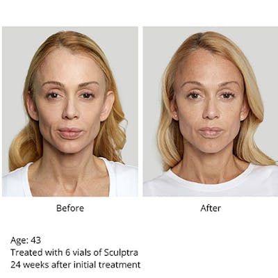 Sculptra Before & After Gallery - Patient 153156491 - Image 1