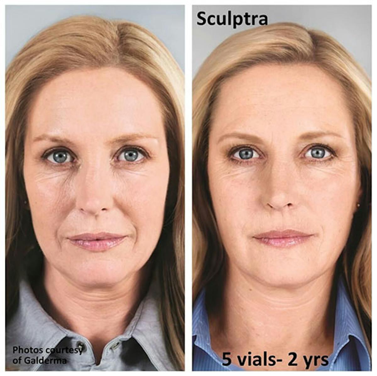 Sculptra Before & After Gallery - Patient 153156493 - Image 1