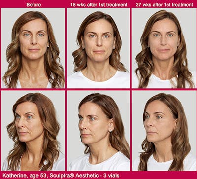 Sculptra Before & After Gallery - Patient 153156492 - Image 1