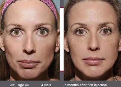 Sculptra Before & After Gallery - Patient 153156490 - Image 1