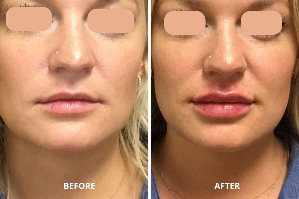 Lip Fillers Before & After Gallery - Patient 204044 - Image 1