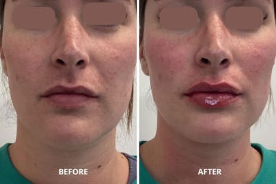 Lip Fillers Before & After Gallery - Patient 181835 - Image 1