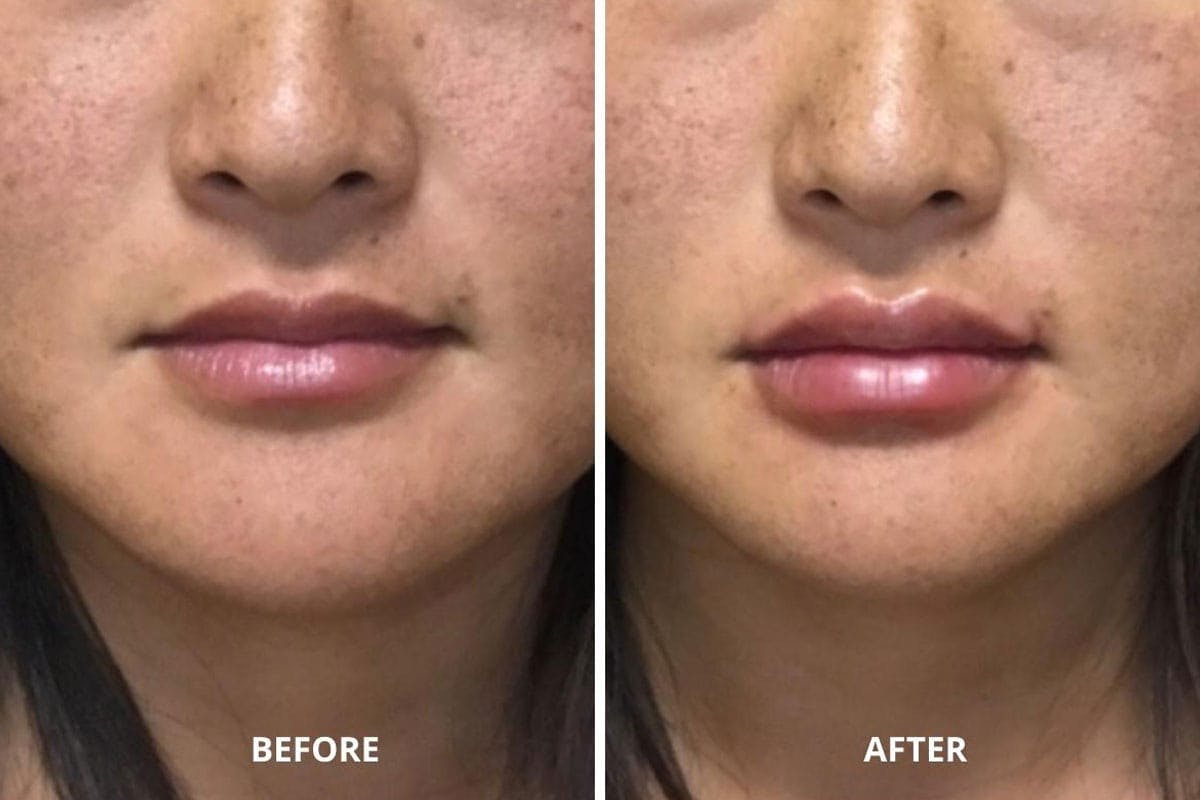 Lip Fillers Before & After Gallery - Patient 203738 - Image 1