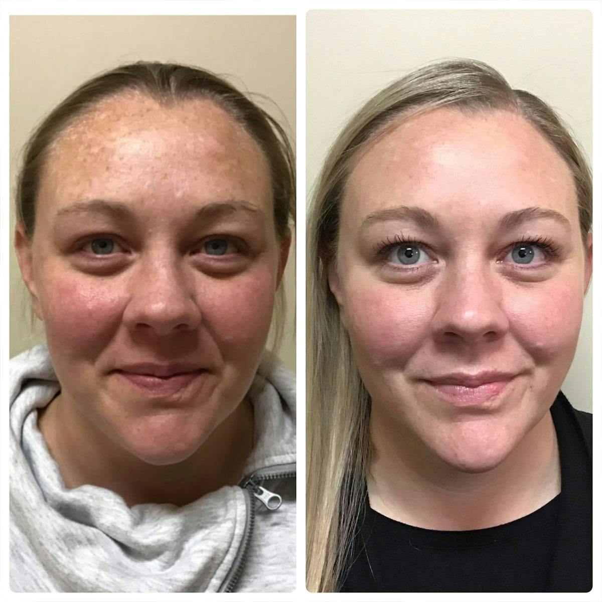Glow Up Before & After Gallery - Patient 121377479 - Image 1