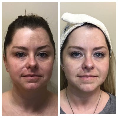 Glow Up Before & After Gallery - Patient 121377509 - Image 1
