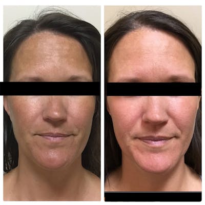 Glow Up Before & After Gallery - Patient 121377513 - Image 1