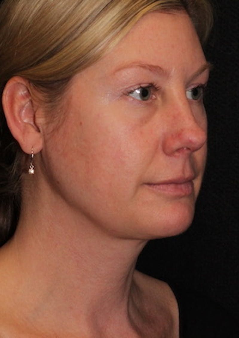 Facetite Before & After Gallery - Patient 117645732 - Image 4