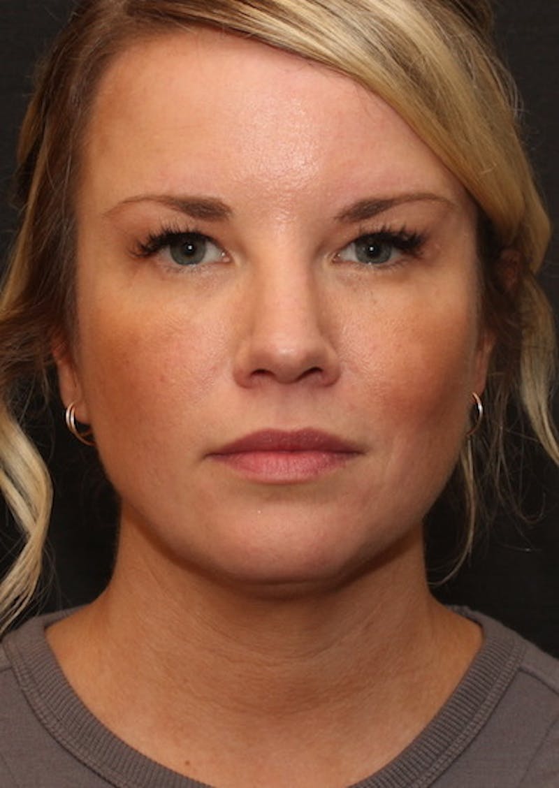 Facetite Before & After Gallery - Patient 117645734 - Image 6