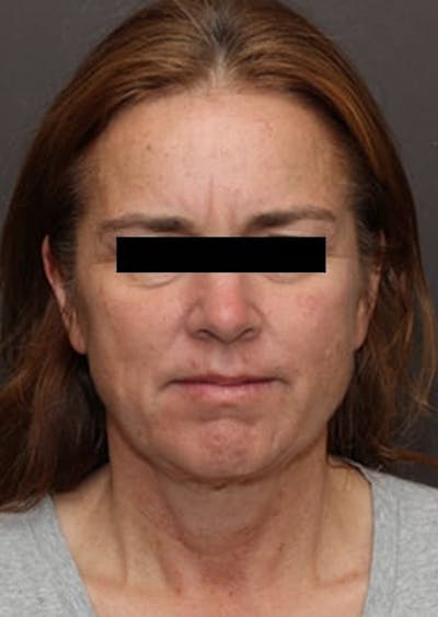 Facelift/Necklift Before & After Gallery - Patient 117645740 - Image 1