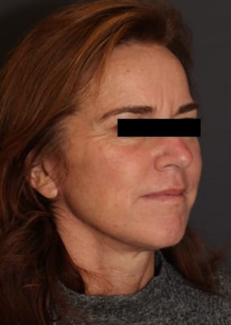 Facelift/Necklift Before & After Gallery - Patient 117645740 - Image 4