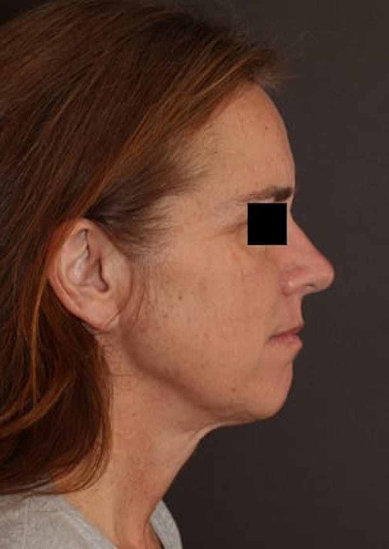 Facelift/Necklift Before & After Gallery - Patient 117645740 - Image 7