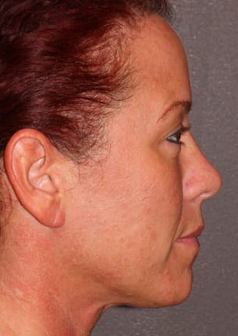 Facelift/Necklift Before & After Gallery - Patient 117645741 - Image 7