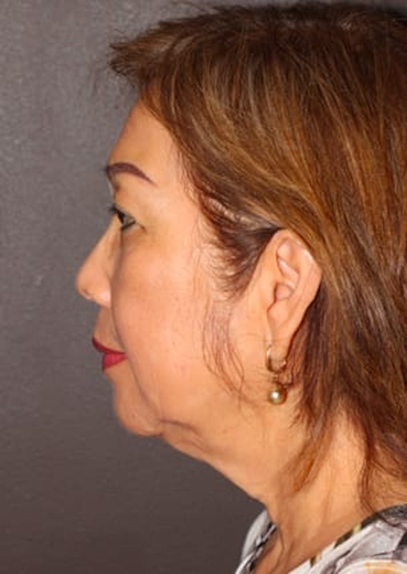 Facelift/Necklift Before & After Gallery - Patient 117645742 - Image 9