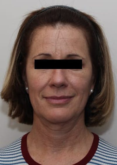 Facelift/Necklift Before & After Gallery - Patient 117645743 - Image 1