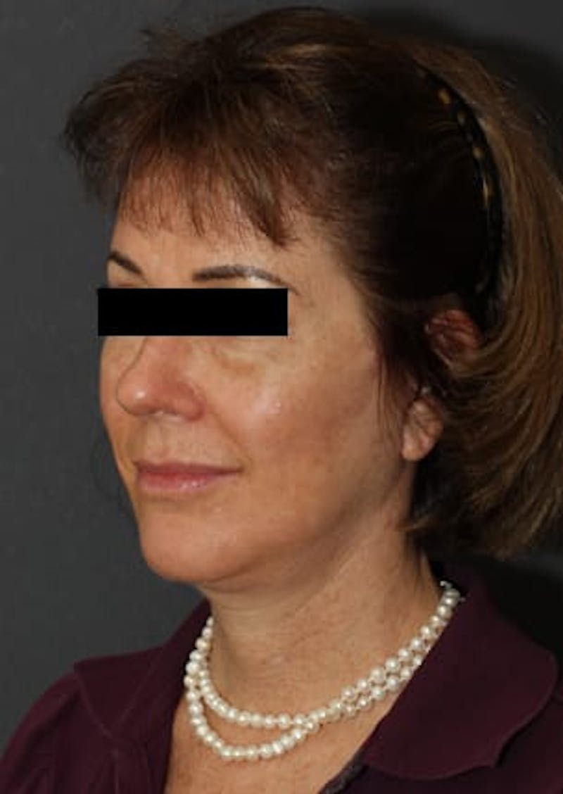 Facelift/Necklift Before & After Gallery - Patient 117645743 - Image 6