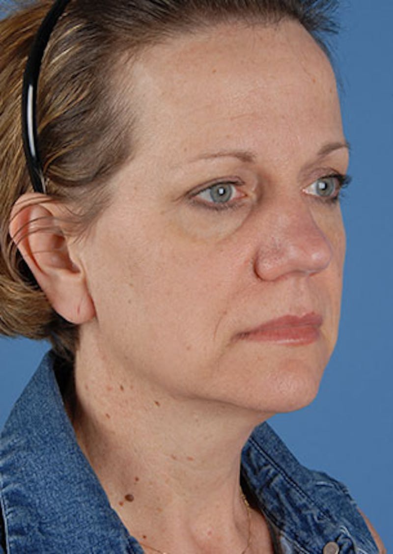 Facelift/Necklift Before & After Gallery - Patient 117645744 - Image 3