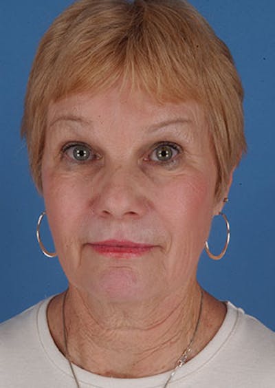 Facelift/Necklift Before & After Gallery - Patient 117645745 - Image 1