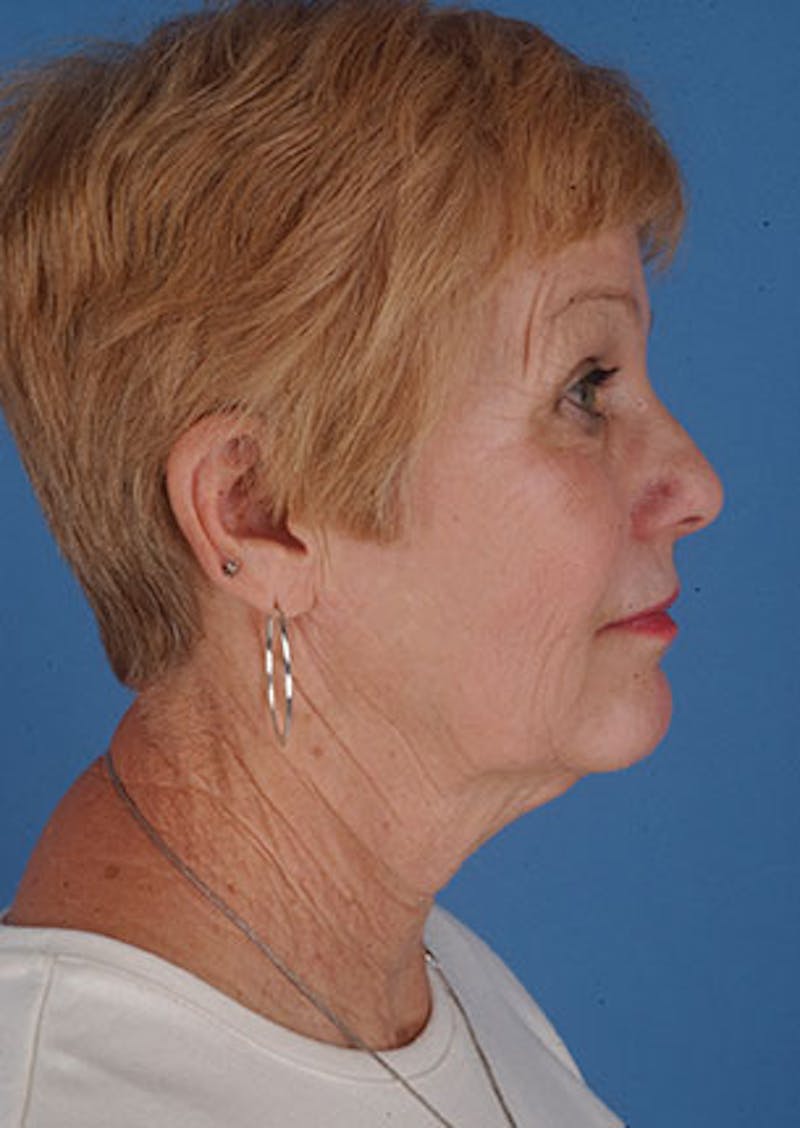 Facelift/Necklift Before & After Gallery - Patient 117645745 - Image 7
